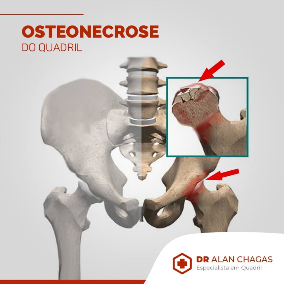 Laser ajuda a tratar lesões decorrentes da osteonecrose – AUN