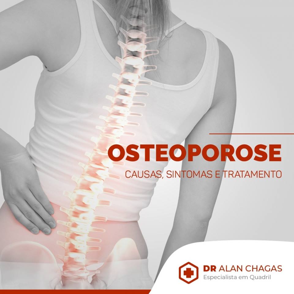 Osteoporose Causas Sintomas e Tratamento Drº Alan Chagas