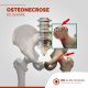 Osteonecrose no Quadril