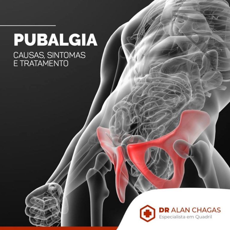 Pubalgia Causas Sintomas e Tratamento Drº Alan Chagas