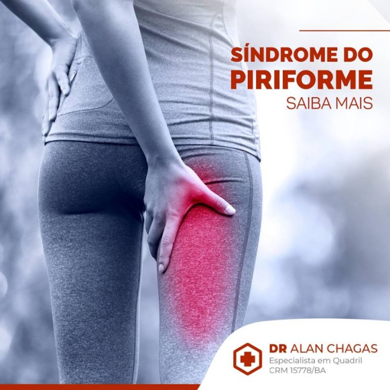 Síndrome do Piriforme Saiba Mais Drº Alan Chagas